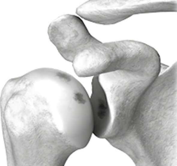 Articulation d'épaule avec un cartilage défectueux
