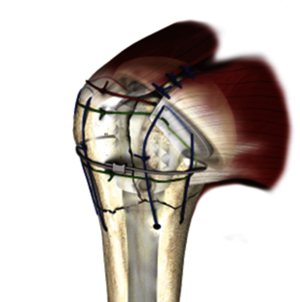 Epaule fracturée portant une prothèse pour fractures