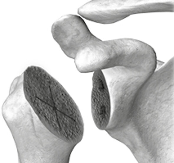 Les os sont préparés pour recevoir les composants prothétiques