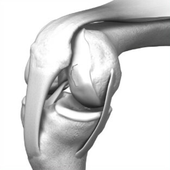 Articulation de genou avec un cartilage défectueux