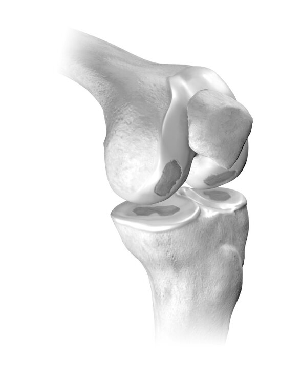 Genou affecté d'arthrose présentant des dommages cartilagineux facilement discernables