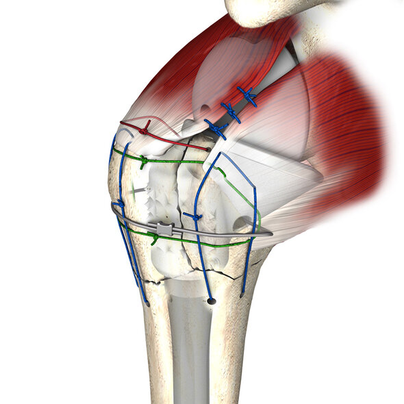 Epaule portant une prothèse inversée