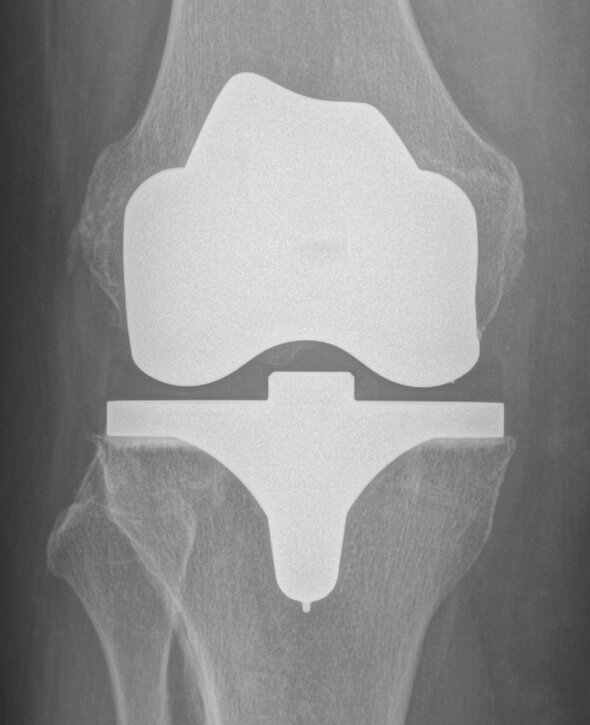 Cliché radiologique après l'opération menée avec succès